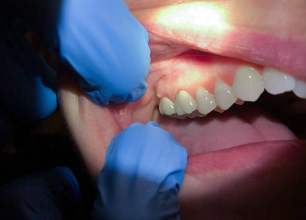 Best Emergency Root Canal Treatment in Hillcrest Heights, MD